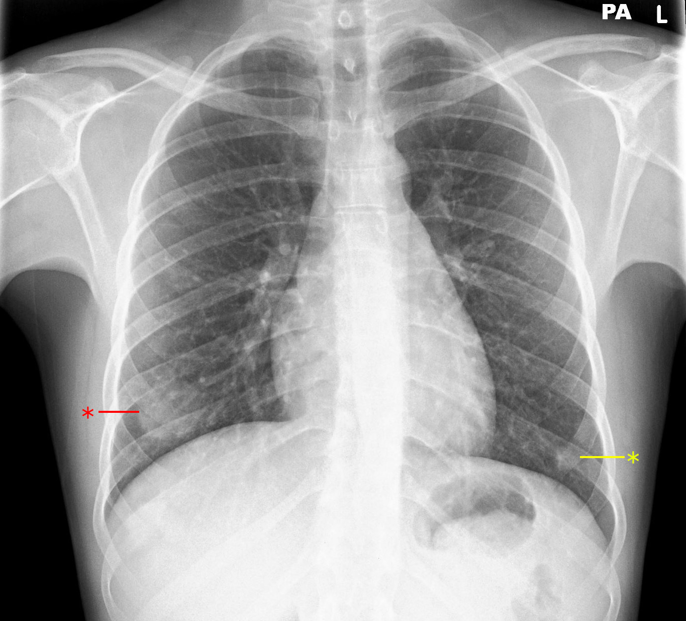 Image of the Month February 2020 - Haemoptysis and an unusual 'lung ...