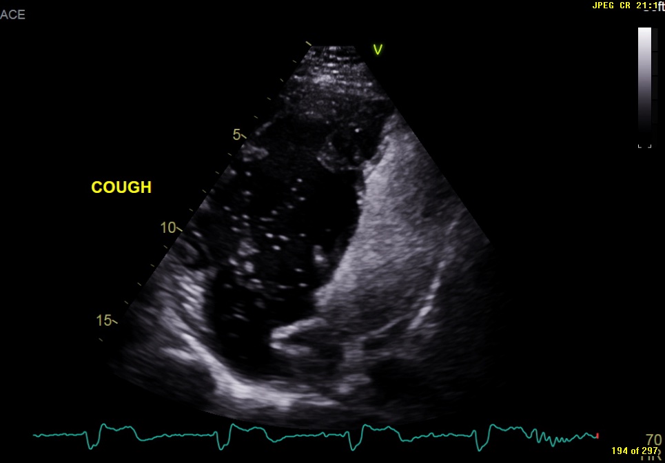Image of the Month October 2021 Value of an agitated saline bubble contrast ECHO in confirming