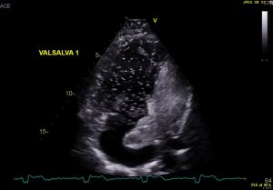 Image of the Month October 2021 –  Value of an agitated saline bubble contrast ECHO in confirming baffle leaks in post atrial switch for TGA patients