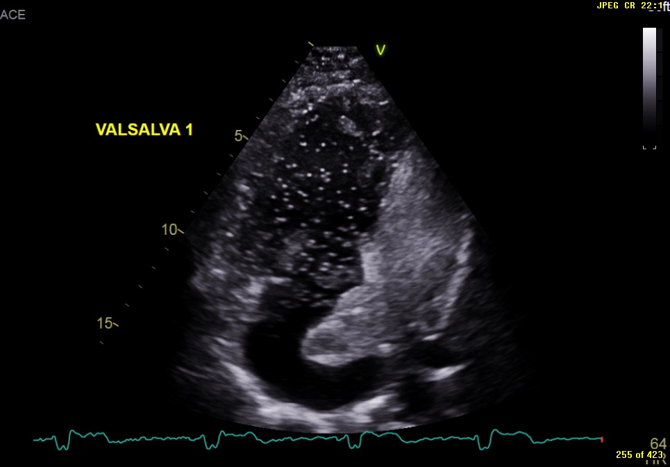 Image of the Month October 2021 Value of an agitated saline bubble contrast ECHO in confirming