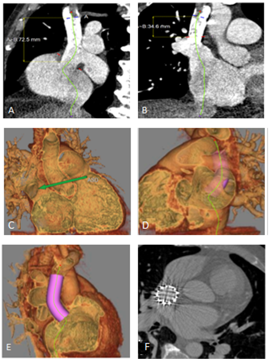 Image of the Month November 2021 –  Computed Tomographic simulation of the anatomical result post transcatheter repair of a sinus venosus defect and partial anomalous pulmonary venous drainage.