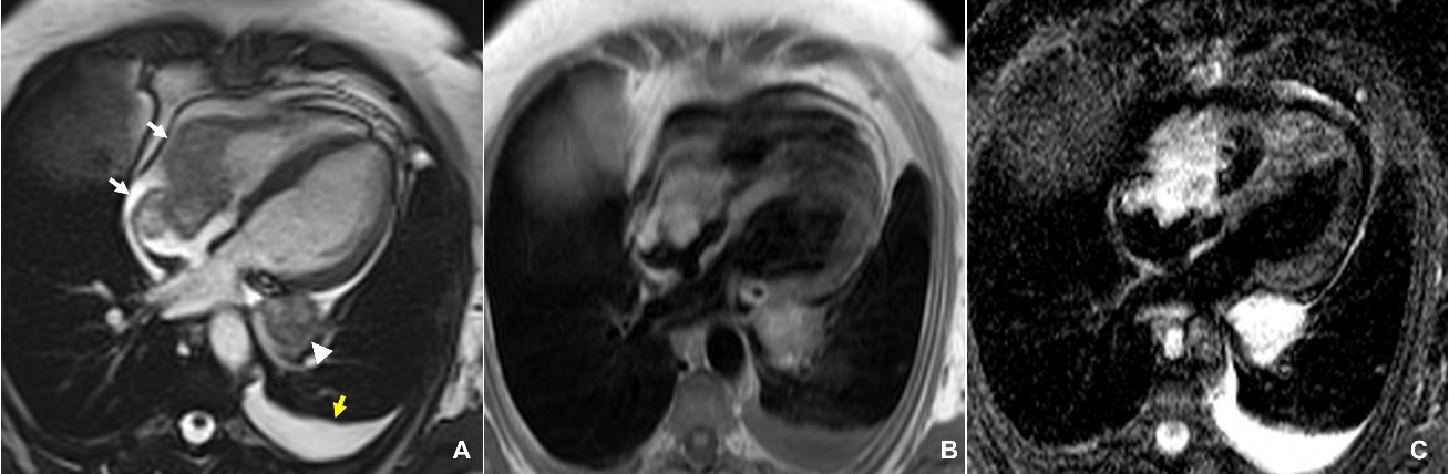 Image of the Month January 2022: Just a benign mass? Value of cardiac magnetic resonance imaging in the diagnosis of cardiac tumours